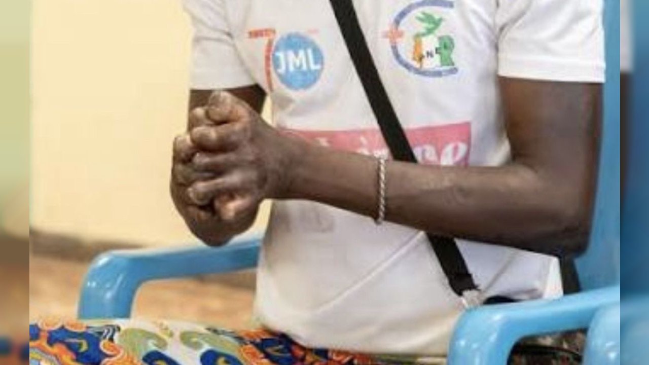 la lèpre n’es pas une fiction venons en aide…